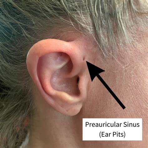 Preauricular Pit Infection