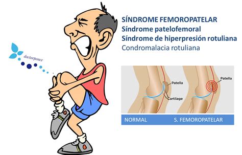 S Ndrome Femoro Patelar Cl Nica Reumatol Gica Dr Ponce