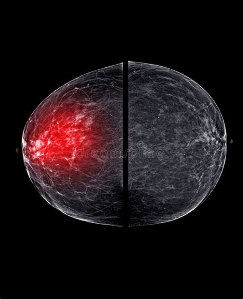 X Ray Digital Mammogram Or Mammography Of Both Side Breast Standard