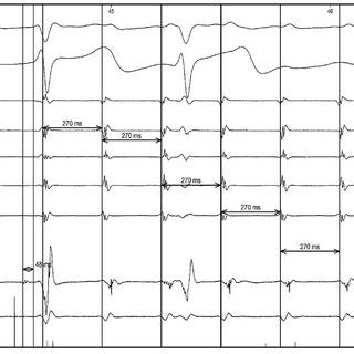 Surface Electrocardiogram V And V And Intracardiac Electrograms