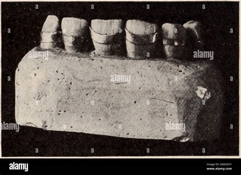 Necrotic tissue hi-res stock photography and images - Alamy