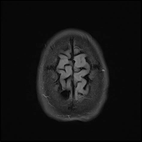 File:Gyrus rectus, cingulate gyrus and caudate head infarction post ACA ...