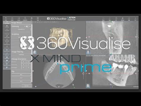 Acteon Xmind Prime General Cbct Overview Of Ais D Software Youtube