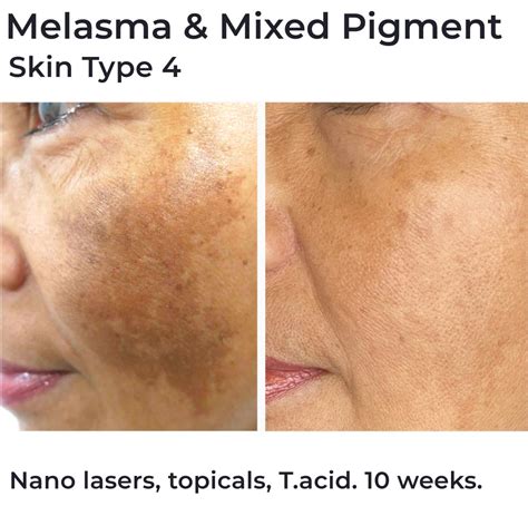 Best Melasma Treatment Packages Brisbane Cutis Dermatology