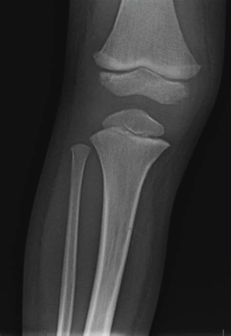 Anteroposterior A And Lateral B Plain Radiographs Of The Patient At