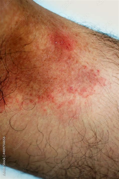 How To Treat Heat Rash In The Groin Area In Males At Paul Crook Blog