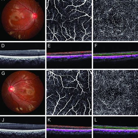 Fundus Examination Optical Coherence Tomography Oct Angiography And