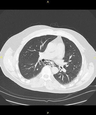 Esophageal Perforation And Its Treatment Image Radiopaedia Org