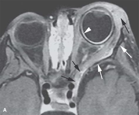 Benign And Malignant Peripheral Nerve Sheath Tumors Radiology Key