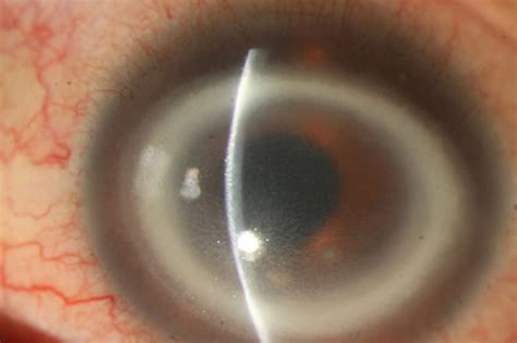 Keratitis Causes Symptoms Diagnosis Prevention Treatment