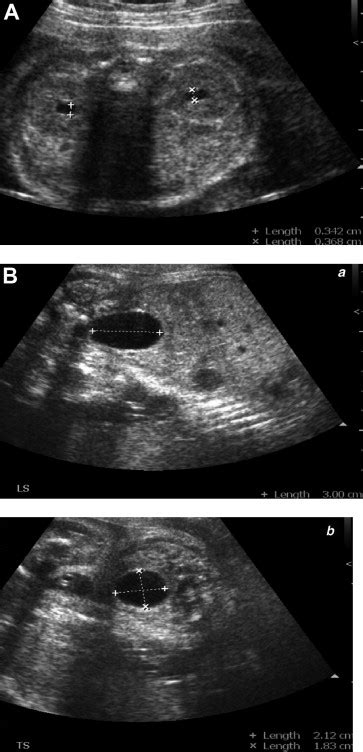 Fetal Hydronephrosis