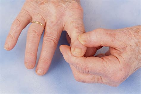 Treatment Recommendations For Hand Osteoarthritis