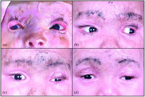 Lamellar Ichthyosis Treatment