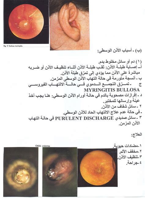 المدونة الطبية دفهيد سالم السبيعي افرازات الاذن Ear Discharge