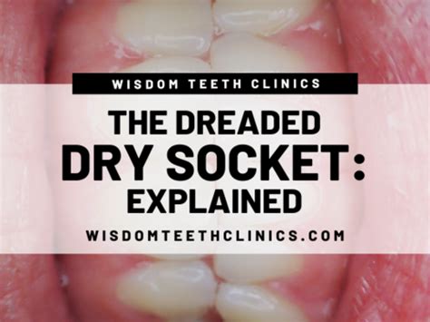 Dry Socket Wisdom Teeth Stitches