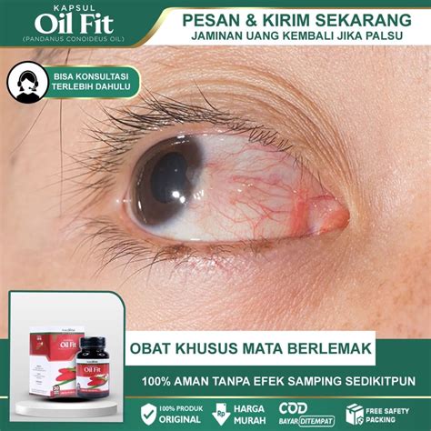 Jual Obat Mata Berlemak Pterygium Diplopia Mata Merah Penipisan Kornea