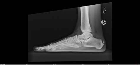 Insertional Achilles Calcific Tendonitis — Chicago Foot And Ankle Orthopaedic Surgeons