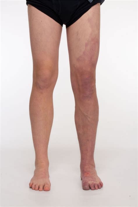 Orthopaedic Diagnoses In Patients With Klippel Trenaunay Syndrome