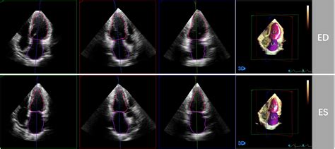 Frontiers Left Heart Chamber Volumetric Assessment By Automated Three