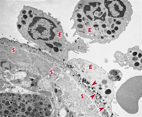 Hypersensitivity Type I Oncohema Key