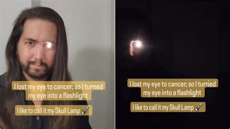 This Man Turned His Eye Into A Flashlight After Losing It To Cancer Video Is Viral India Today