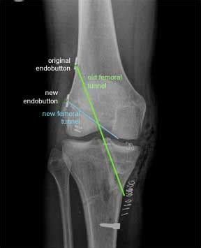 ENDOBUTTON ACL PDF