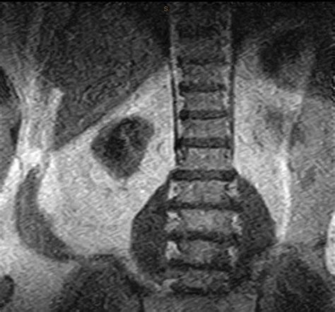 Lumbar Spine Lumbar Spine Without Contrast