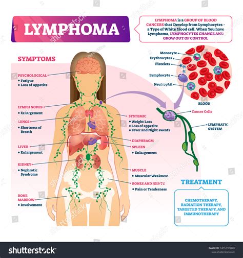 618 Lymphoma symptoms Images, Stock Photos & Vectors | Shutterstock