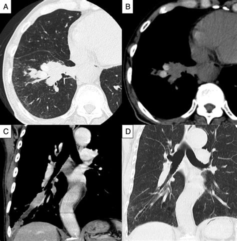 High Attenuation Mucus In Allergic Bronchopulmonary Aspergillosis