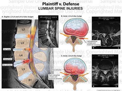 Disc Bulges Stenosis L L Motionlit