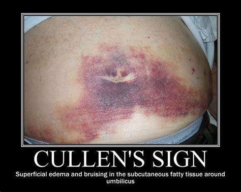 Cullen Sign seen in pancreatitis | Nurse practioner, Ovarian cyst, Ovarian