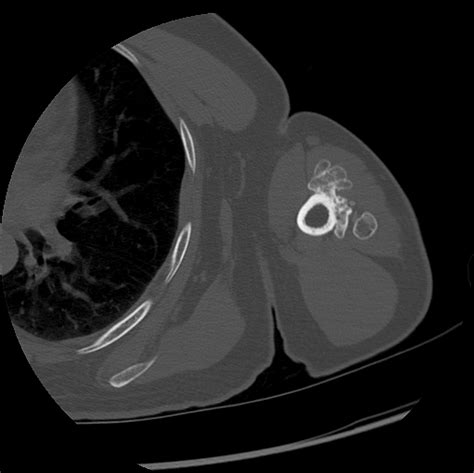 Bizarre Parosteal Osteochondromatous Proliferation Image