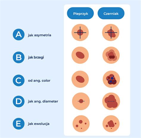 Jak odróżnić pieprzyka od czerniaka Porozumienie Łódzkie