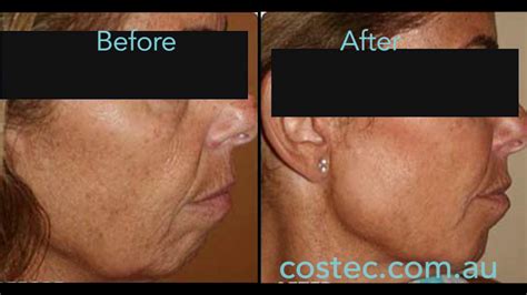 HIFU Facial What Is It How It Works Effects Cost And 53 OFF