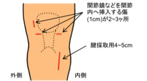 手術前診察´ｰ` Acl再建術とは？ 前十字靭帯断裂からの再建手術！omgΣ ⌓