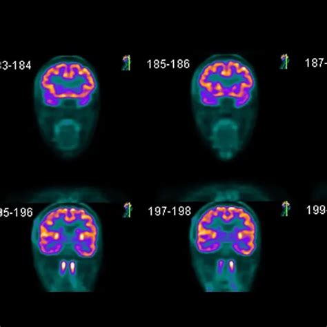 What Is The Procedure Of Brain PET Scan? | Ganesh Diagnostic