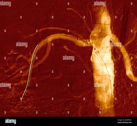 Angioplastia Renal Angiograf A De Rayos X De Color De Un Cat Ter De