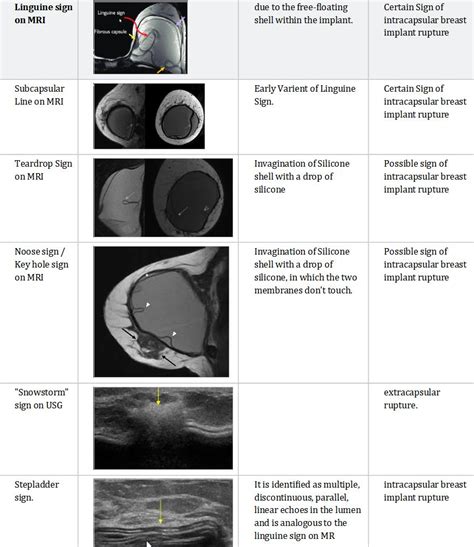 Radiological Signs Of Breast Implant Rupture