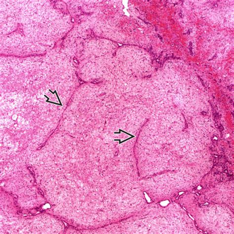 Mesenchymal Hamartoma Basicmedical Key