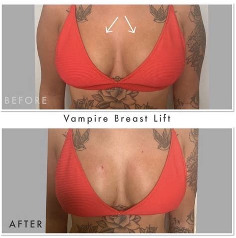 Pdo Thread Lift Breast Before And After Glpna