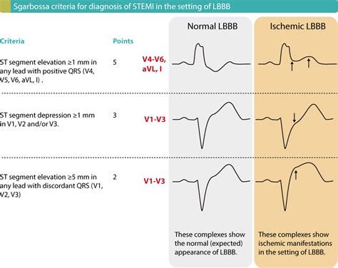 Stemi Infarctus Du Myocarde Avec Sus D Calage Du Segment St