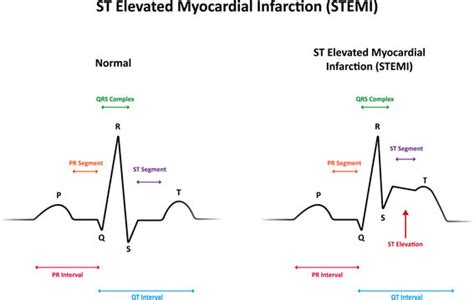 Ecg Interpretation Characteristics Of The Normal Ecg