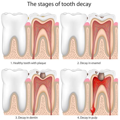 Cavities Sf Dental Arts