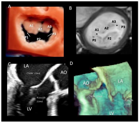 Jcdd Free Full Text Anatomy Of Mitral Valve Complex As Revealed By