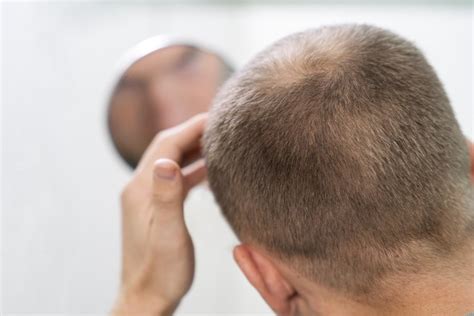 Tipos De Alopecia Masculina Blog De Pilexil