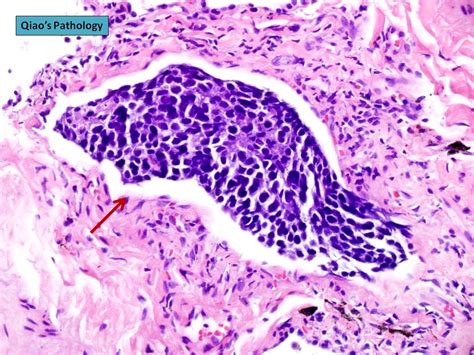 Qiaos Pathology Small Cells Carcinoma Of The Lung 乔氏病理学… Flickr