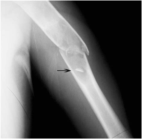 Simple Bone Cyst Fallen Fragment Sign