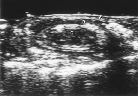 Intussusception In Children Current Concepts In Diagnosis And Enema