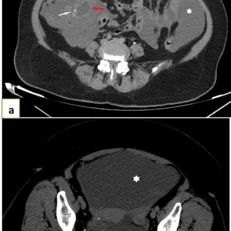 Abdominal Post Injection Ct Scan Showing A Cystic Mass In The Right