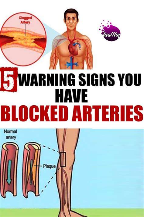 Here are 5 warning signs you have blocked arteries in 2020 | Arteries ...